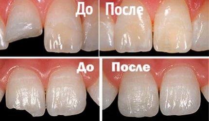 Анатомическая реставрация зуба