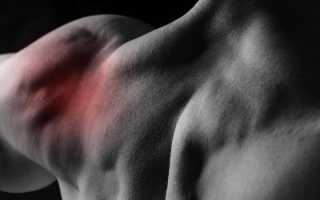 Симптомы плечелопаточного периартрита — механизм развития заболевания
