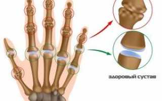 Лечение артрита пальцев рук народными средствами
