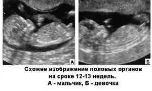 Определение пола ребенка на 12 неделе беременности