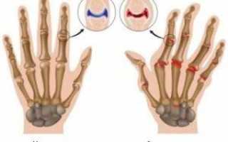Артроз артрит кистей рук лечение