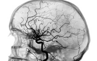 УЗИ сосудов головного мозга: что выявляет метод диагностики