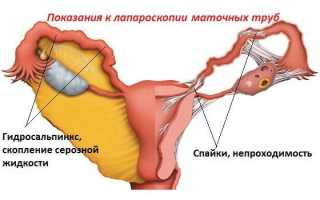 Последствия после лапароскопии маточных труб — спайки и бесплодие