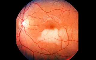 Контузия глаза — симптомы, степени тяжести, методы лечения, осложнения