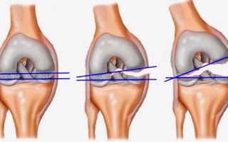 Разрыв связок коленного сустава симптомы