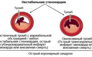 Стенокардия напряжения — причина возникновения, симптомы и лечение