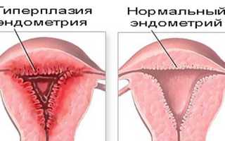 Гиперплазия эндометрия в постменопаузе