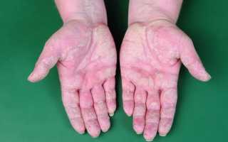 Мази от артрита пальцев рук