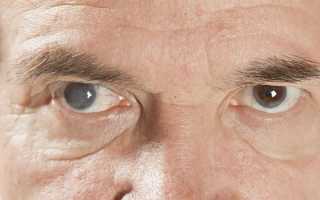Причины бельма на глазу у человека — описание и виды заболевания, методы лечения, последствия