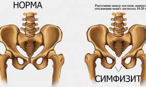 Боль в лобковых костях во время беременности