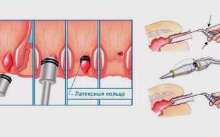 Лигирование геморроидального узла