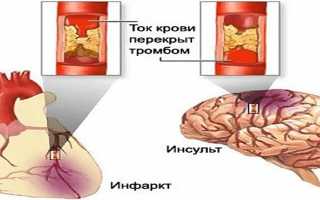 Отличие инфаркта от инсульта — причины возникновения и схожие симптомы, диагностика, методы лечения