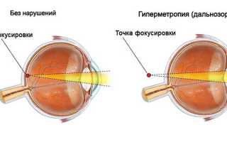 Гиперметропия у детей — степени, симптомы и лечение