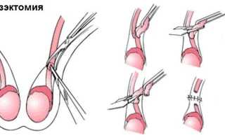 Вазэктомия у мужчин, что это за операция и последствия