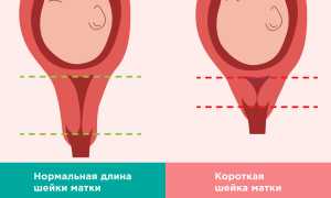 Короткая шейка матки при беременности