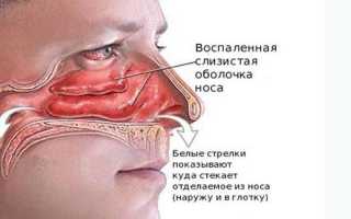 Что такое ринит у детей и взрослых — симптомы и лечение