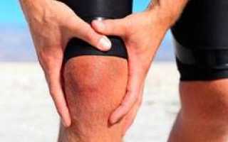 Бурсит коленного сустава лечение