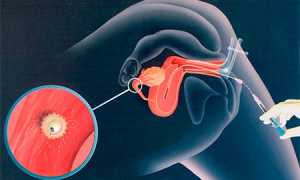 Внутриматочная инсеминация