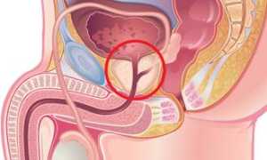 Истории о простатите
