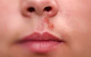 Что делать с болячками в носу?