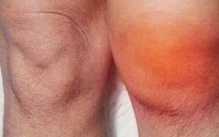 Гнойный артрит коленного сустава