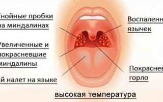 Симптомы и лечение тонзиллита у детей или взрослых