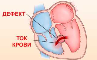 Пороки сердца у детей