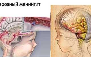 Менингит у новорожденных — причины, симптомы и последствия