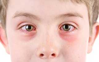 Аденовирусный конъюнктивит у детей — симптомы, причины и формы заболевания, методы лечения