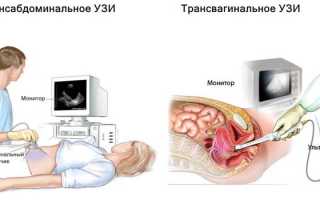 Как проводится фолликулометрия и показания к УЗИ-исследованию