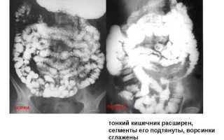 Рентген кишечника — подготовка, проведение и что показывает