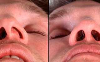 Исправление перегородки носа – цель или средство