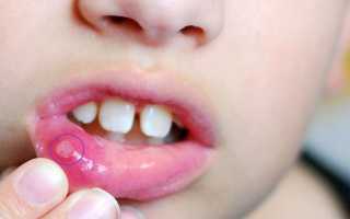 Язвенный стоматит у детей – лечение медикаментами или народными средствами, диета
