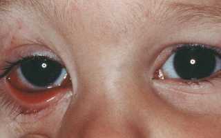 Причины аллергического конъюнктивита у ребенка и взрослого