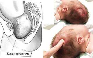 Шишка на голове у новорожденного