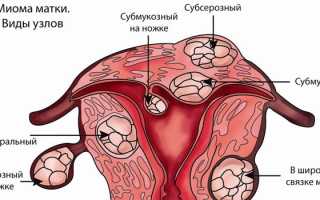 Субсерозная миома матки