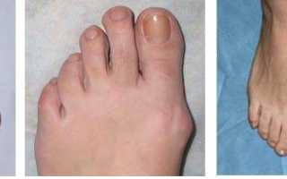 Артроз на пальцах ног