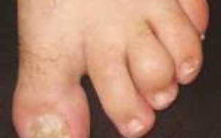 Воспаление сустава большого пальца ноги