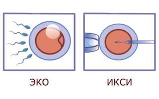 ЭКО и ИКСИ