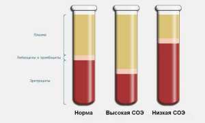 СОЭ у ребенка