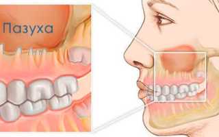 Особенности гайморита от больного зуба