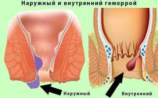 Геморрой у женщин — признаки, стадии и лечение в домашних условиях