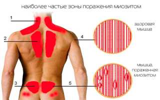 Симптомы и лечение миозита