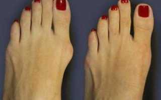 Бурсит пальца ноги лечение