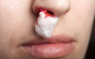 Ранки в носу – причины возникновения и способы лечения