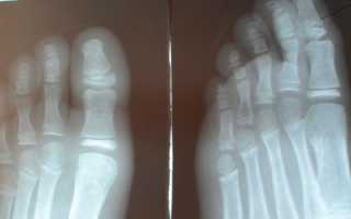 Признаки перелома большого пальца на ноге