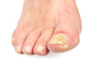 Народные средства от грибка ногтей на ногах — обзор эффективных рецептов для лечения в домашних условиях