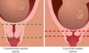 Истмико-цервикальная недостаточность