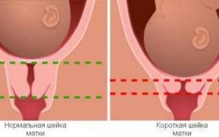 Истмико-цервикальная недостаточность