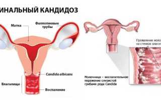 Вагинальный кандидоз: причины и лечение